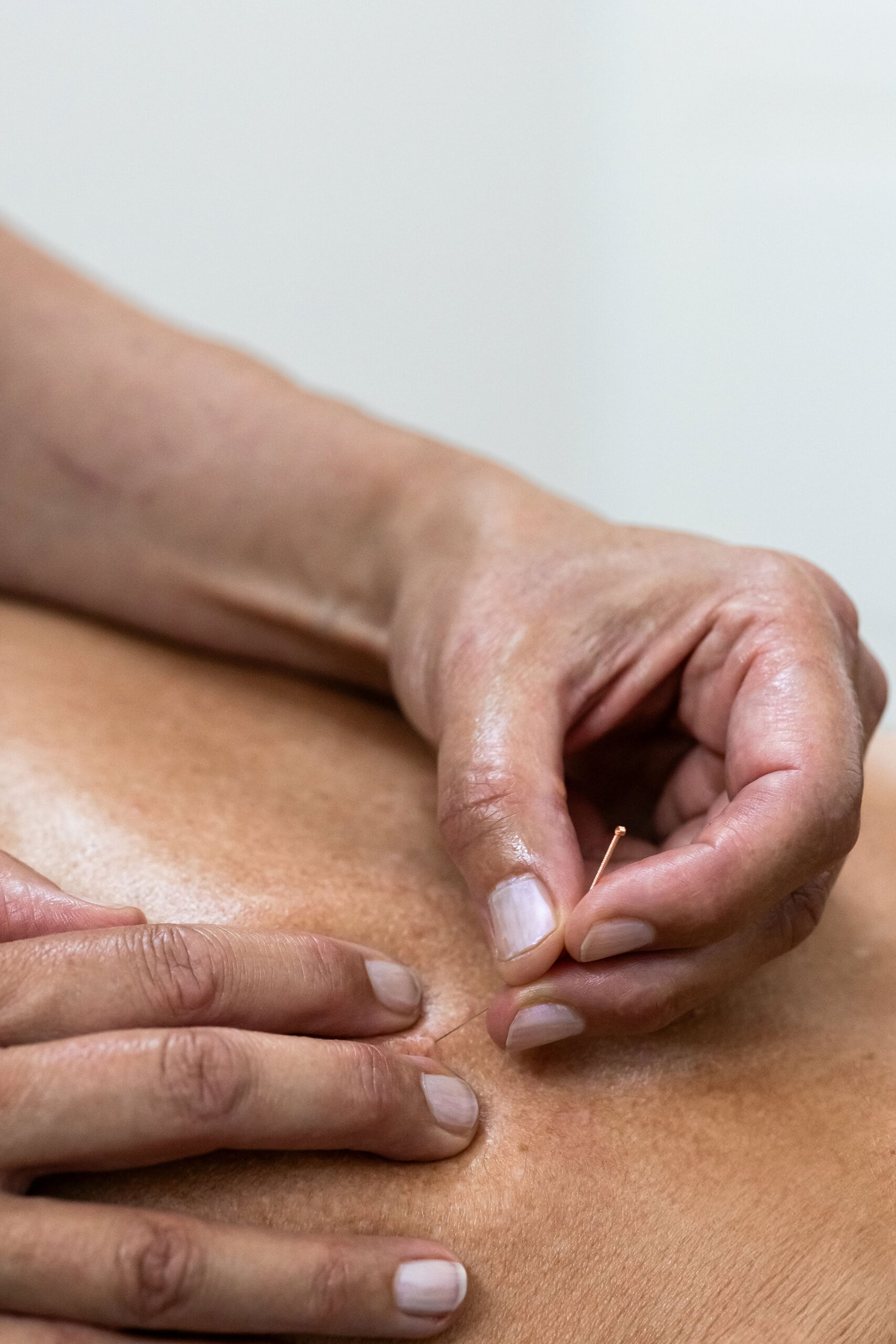 Dry needling: hetzelfde woord, een wereld van verschil